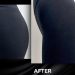 تزریق ژل به باسن چگونه انجام می شود؟ هزینه + انواع ژل باسن