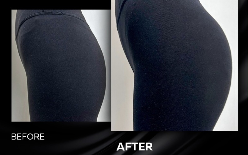 تزریق ژل به باسن چگونه انجام می شود؟ هزینه + انواع ژل باسن