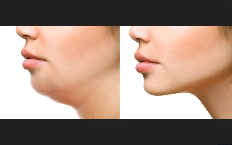 عکس تزریق ژل چانه