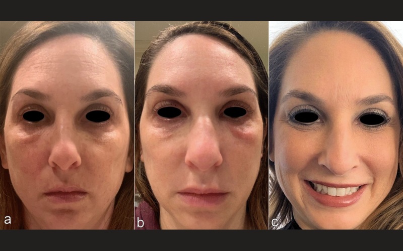 عکس ورم صورت بعد از تزریق ژل