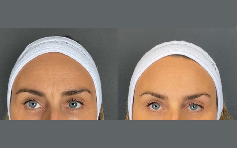 بوتاکس پیشانی زنان و بوتاکس پیشانی مردان با هم فرق دارد؟