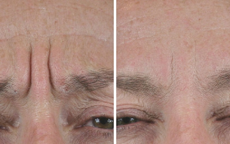 تزریق ژل خط اخم چیست؟