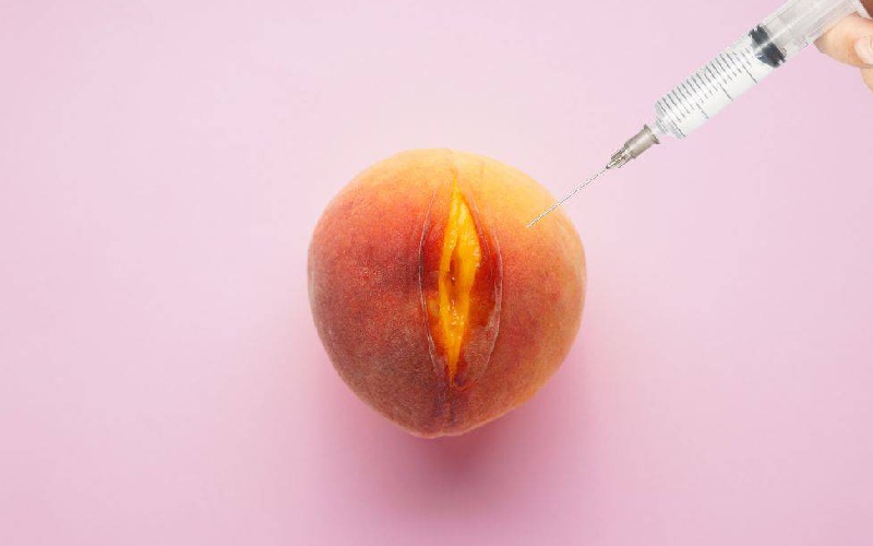 تزریق ژل به لابیا؛ هزینه + آشنایی با نحوه تزریق ژل به لابیا