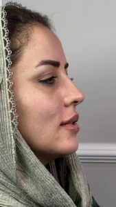 نمونه کار تزریق فیلر ۴