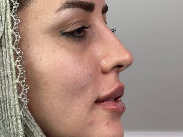 تزریق ژل لب