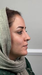 نمونه کار تزریق فیلر ۴