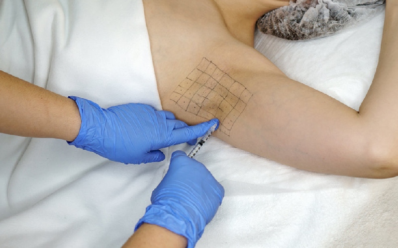 نحوه عملکرد بوتاکس برای تعریق چگونه است؟