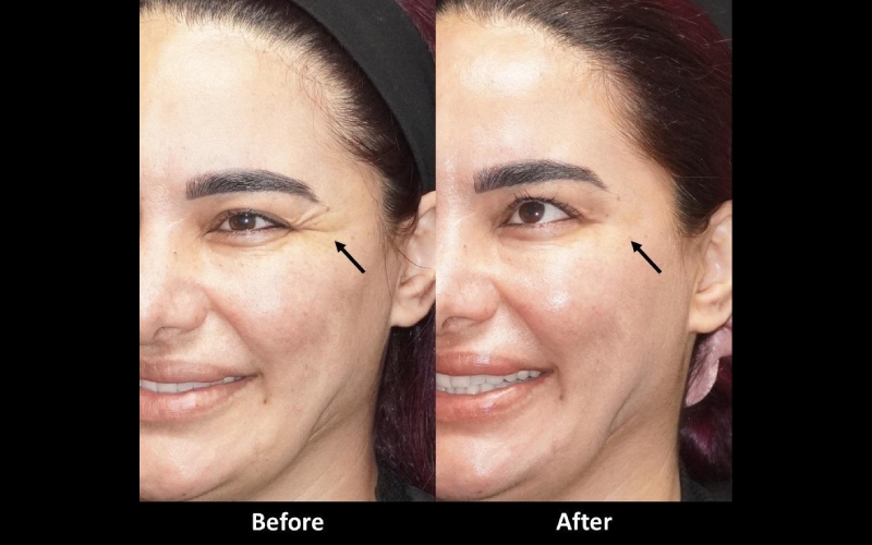 عوارض بوتاکس دور و زیر چشم