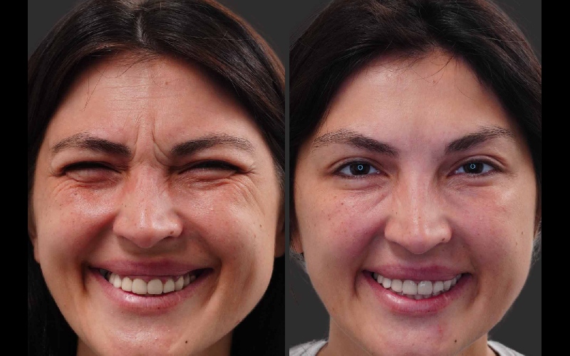 عکس قبل و بعد بوتاکس دور چشم