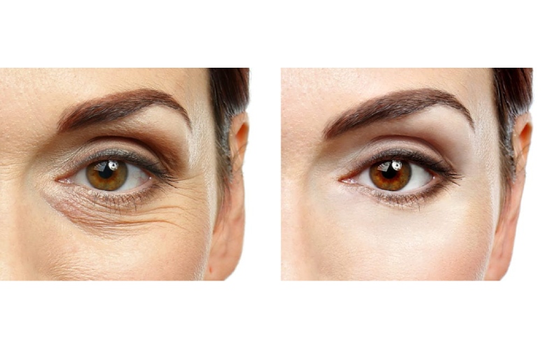 فواید بوتاکس دور و زیر چشم