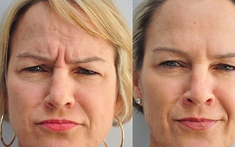 برای خط اخم فیلر بهتره یا بوتاکس؟