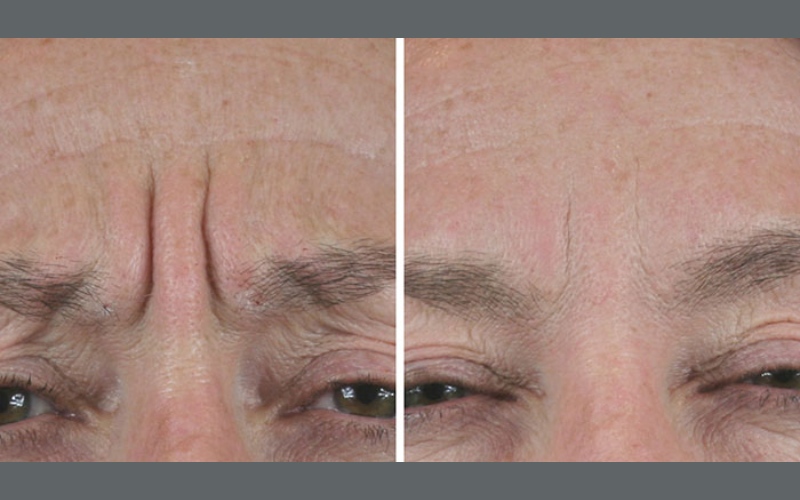 بهترین نوع بوتاکس برای خط اخم