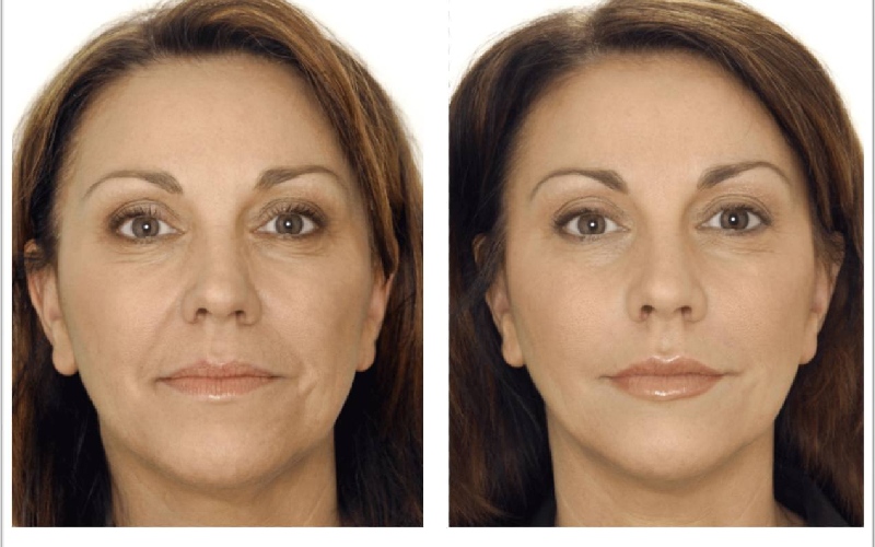 نحوه تزریق بوتاکس خط اخم