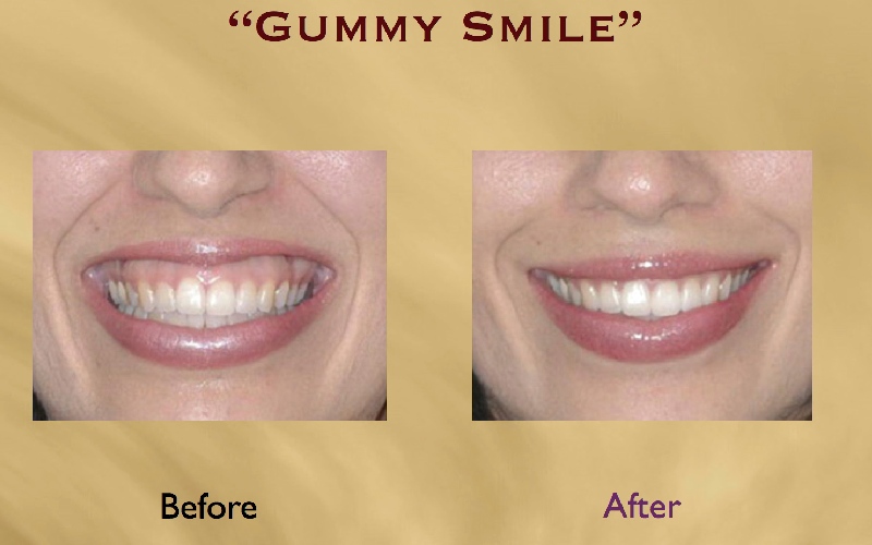 قیمت بوتاکس لبخند لثه ای چقدر است؟