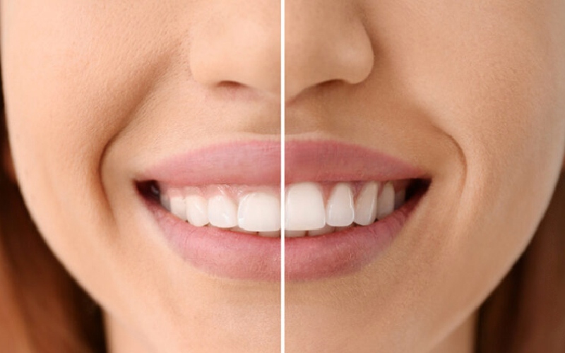 بوتاکس لبخند لثه ای؛ درمان لبخند لثه ای با بوتاکس