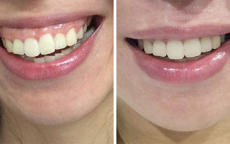 دلیل داشتن لبخند لثه ای چیست؟