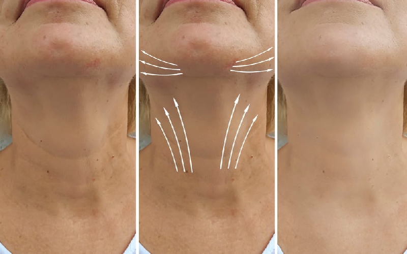 بوتاکس گردن چیست؟ هزینه بوتاکس گردن چقدر است؟