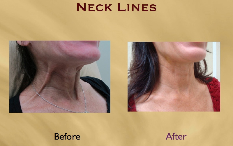 رفع چروک گردن با بوتاکس چگونه انجام می شود؟