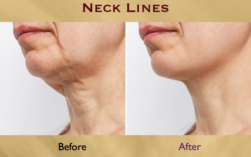 چهره نو بوتاکس گردن