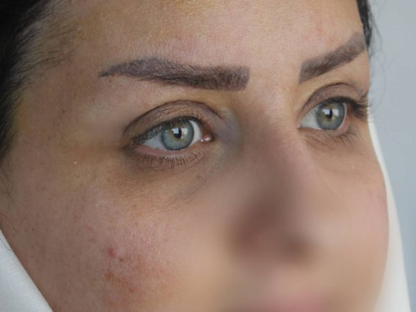 نمونه کار بلفاروپلاستی