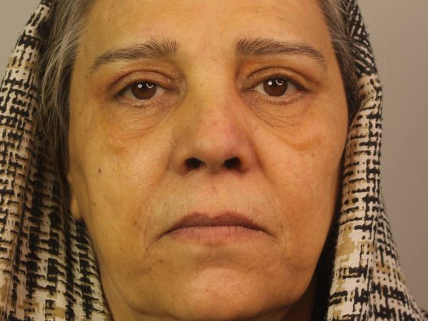 نمونه کار بلفاروپلاستی