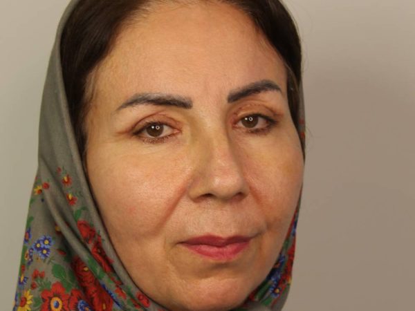 نمونه کار بلفاروپلاستی