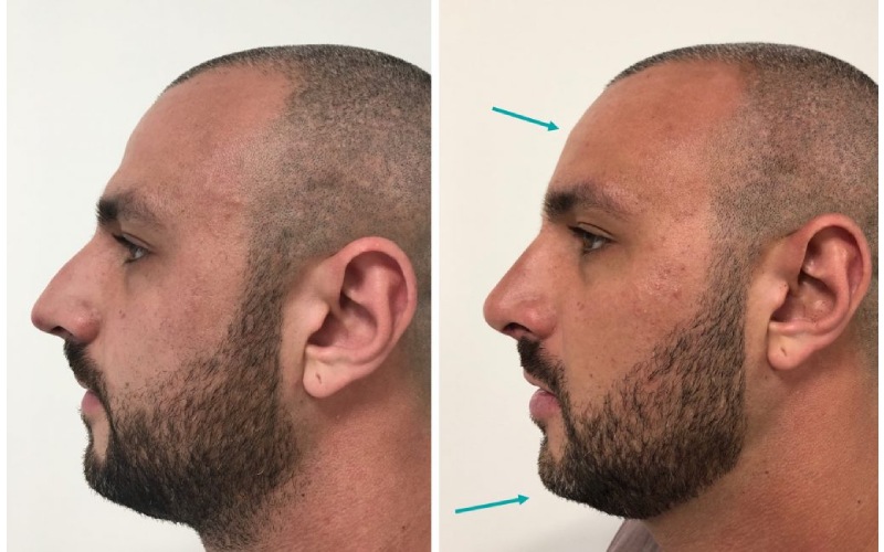 ماندگاری مادلینگ صورت با تزریق چربی چقدر است؟