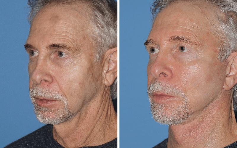 مراقبت های بعد از مادلینگ صورت با تزریق چربی