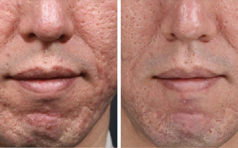 کاربرد میکرونیدلینگ صورت چیست و با چه هدفی انجام می شود؟