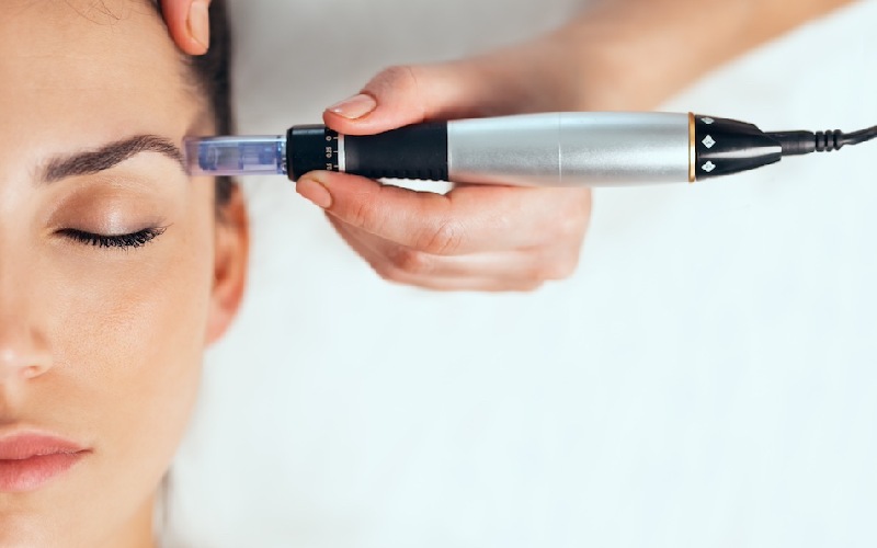 میکرونیدلینگ صورت؛ هزینه و مزایای میکرونیدلینگ صورت