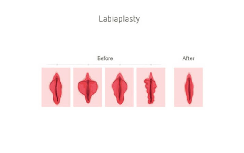 مراقبتهای بعد از عمل لابیاماژور پلاستی شامل چه مواردی است؟