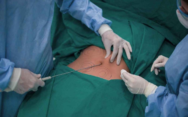 دستگاه لیپوماتیک چگونه کار می کند؟