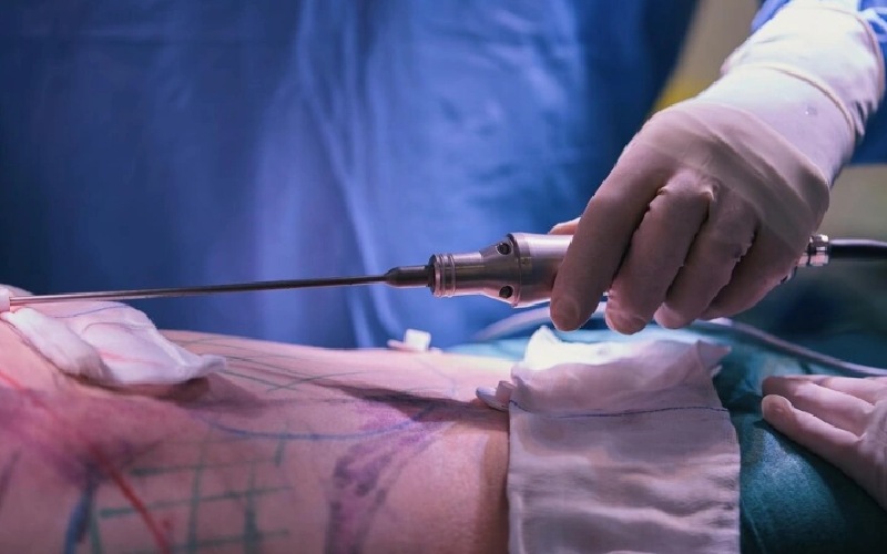 روش های جایگزین لیپوماتیک چیست؟