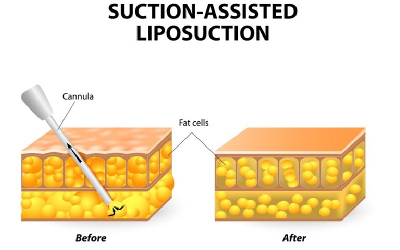 عوارض لیپوساکشن (آیا عمل لیپوساکشن خطرناک است؟)