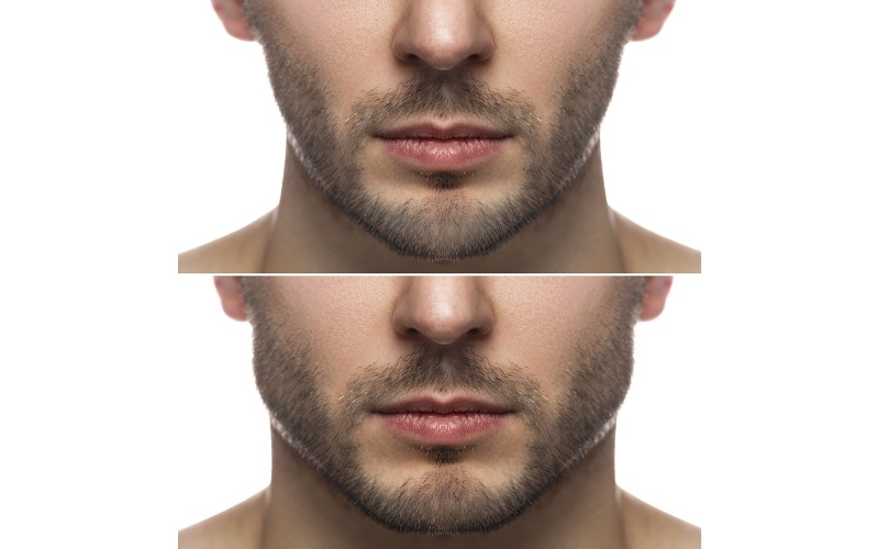 نحوه انجام زاویه سازی صورت کشیده چگونه است؟