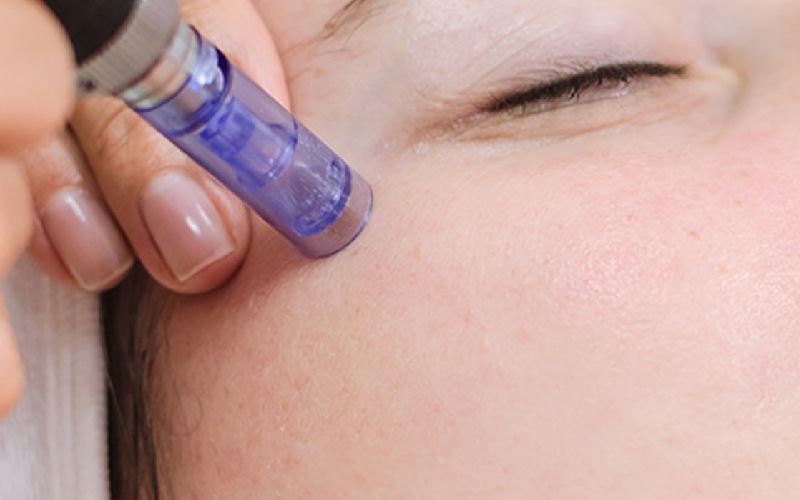 نکات مهم قبل از میکرونیدلینگ شامل چه مواردی است؟