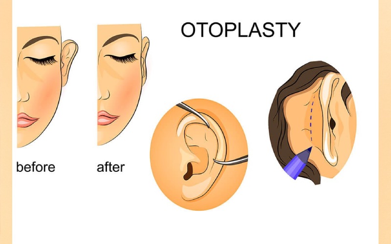 مراقبت های بعد از اتوپلاستی گوش چیست؟