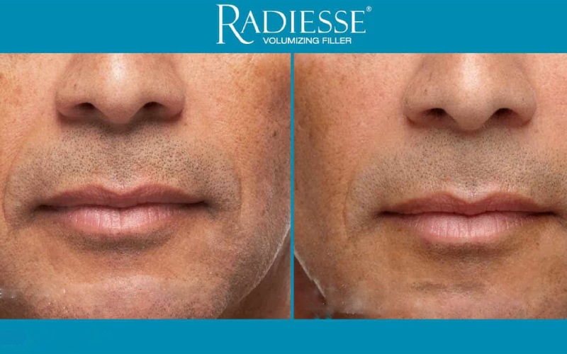 ماندگاری ژل رادیس چقدر است؟